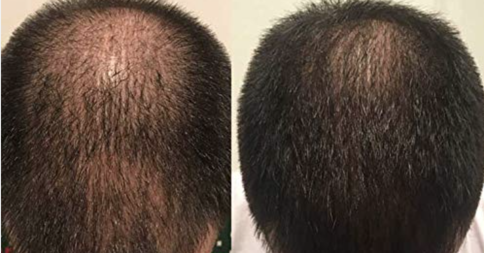 Zenagen Revolve Hair Loss Shampoo Treatment for Men Tribeca Salon Tampa